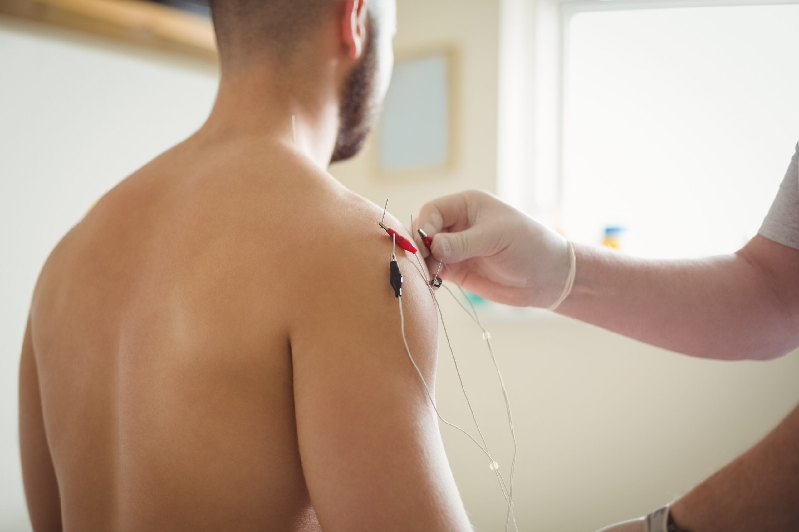 close-up-physiotherapist-inserting-needles-patient